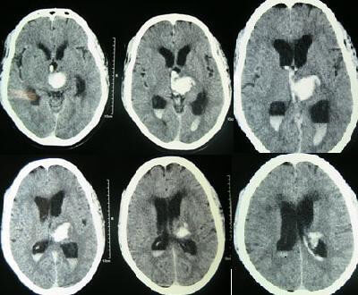 hypoxic-ischemic-encephalopathy