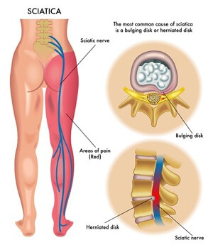 sciatica-pain