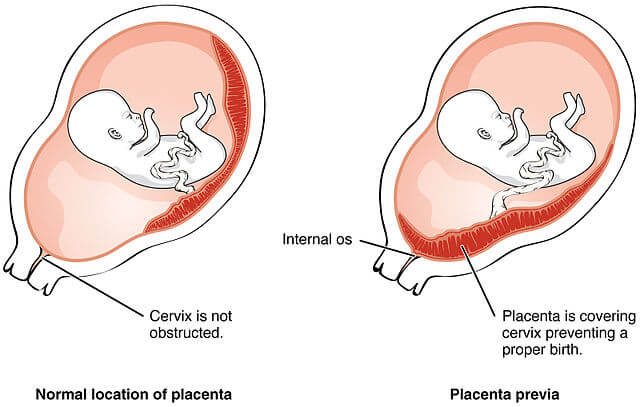 what is placenta privia