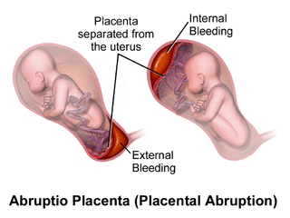placental-abruption