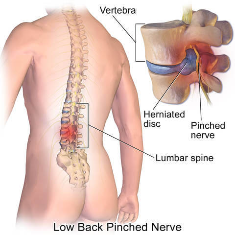 herniated-disc